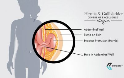 What is a Hernia and How to Treat best 2023