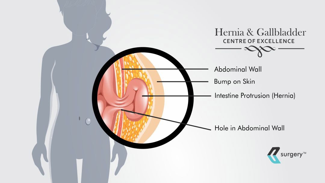 What is a Hernia and How to Treat best 2023