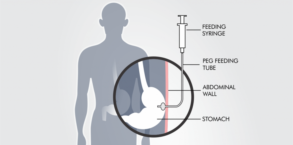 Percutaneous Endoscopic Gastrostomy 