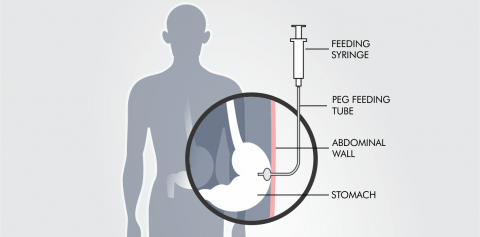 PEG Percutaneous Endoscopic Gastrostomy - Find Out More