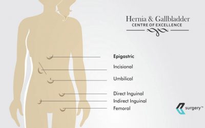 What Types of Hernias Are There And Its Treatment