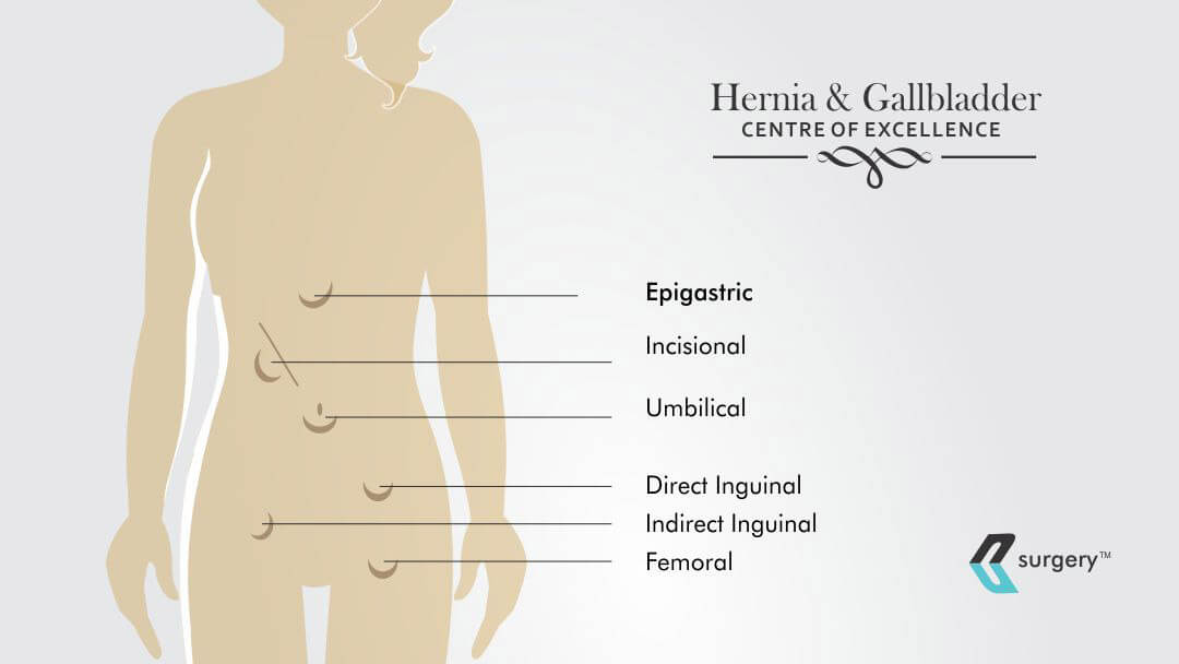What Types of Hernias Are There And Its Treatment
