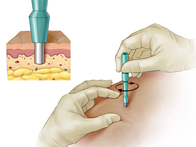 What does a general surgeon do :Illustration of Doctor taking a skin sample with gloves