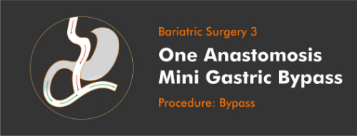 mini-gastric-Weight-Loss-Surgery