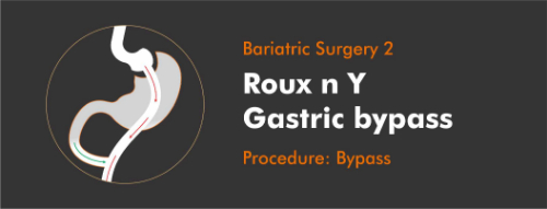 roux and-y-Weight-Loss-Surgery