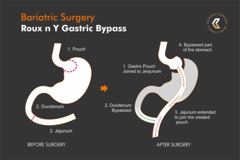 What Is Roux N Y Gastric Bypass Surgery? | Dr Ebrahim Mansoor