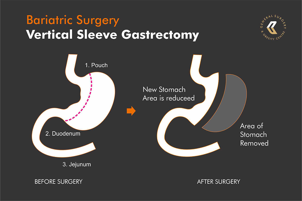 What is the Vertical Sleeve Gastrectomy Illustration