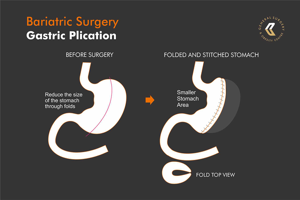 weight loss gsatric-plication-surgery illustration