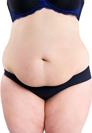 weight loss surgery durban before image of woman