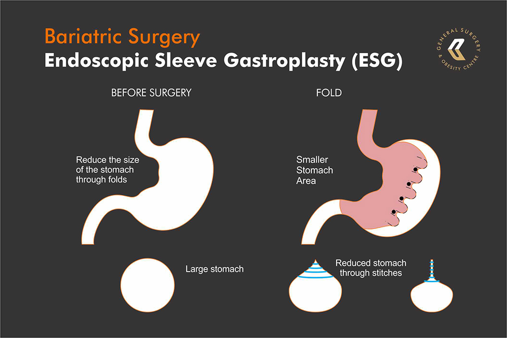 Endoscopic Sleeve Gastroplasty Infographic before and after
